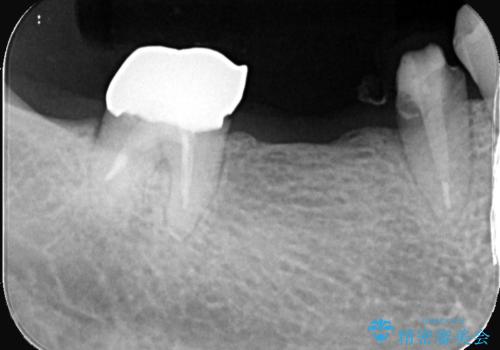 【ゴールドクラウン】セラミックのブリッジが何度も壊れるの治療前