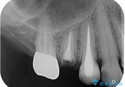 上の奥歯が折れた 抜歯即時埋入インプラントの治療前