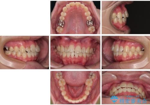 1年でここまで変わる!歯列のがたつきと正中のズレを改善した矯正治療(メタルブラケット×MARPE)の治療後