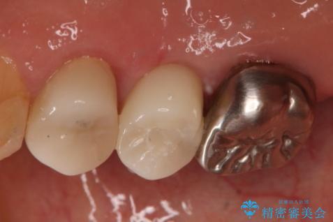 上の奥歯が折れた 抜歯即時埋入インプラントの治療後