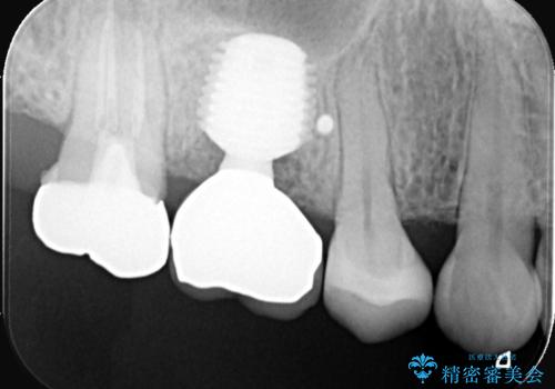歯のひび割れによる奥歯の痛みも即日解決の症例 治療後