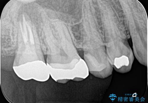 右奥歯治療が必要と言われた。の治療後