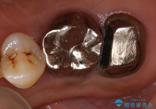 奥歯が取れた フルジルコニアクラウンの症例 治療前