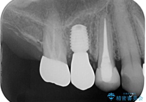 上の奥歯が折れた 抜歯即時埋入インプラントの治療後
