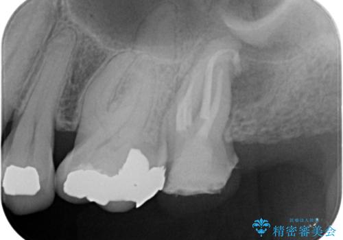 銀歯を白くしたいセラミック治療。の治療中