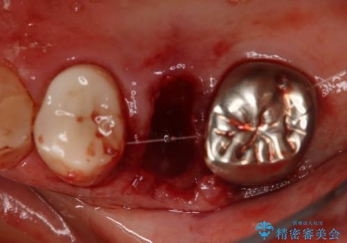 上の奥歯が折れた 抜歯即時埋入インプラントの治療中