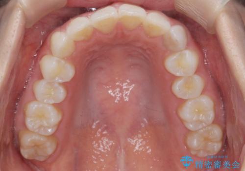 前歯のがたつき気になる。インビザラインモデレートの症例 治療後