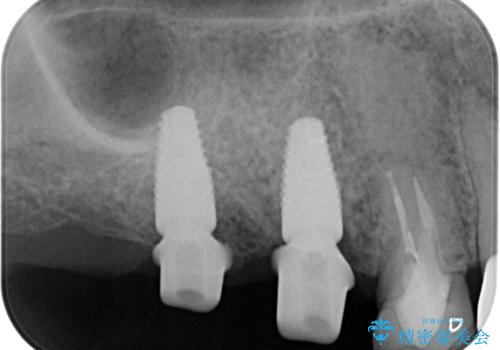 欠損した奥歯 インプラント補綴の治療中