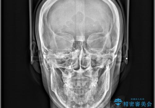 口ボコと歯のデコボコが気になる!|前歯が出ていて口が閉じにくい|審美ワイヤー矯正による口元の改善!の治療後