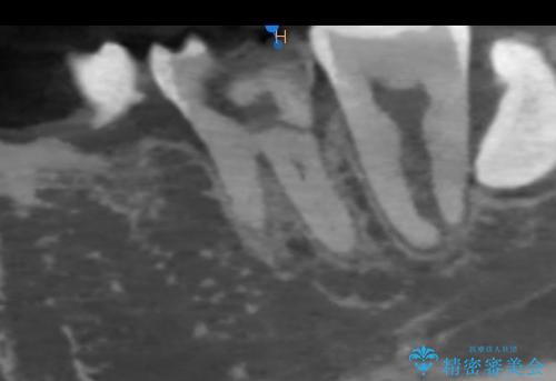 咬合力で破折した奥歯 抜歯即時埋入インプラントによる補綴治療の治療前