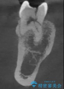 咬合力で破折した奥歯 抜歯即時埋入インプラントによる補綴治療の治療前