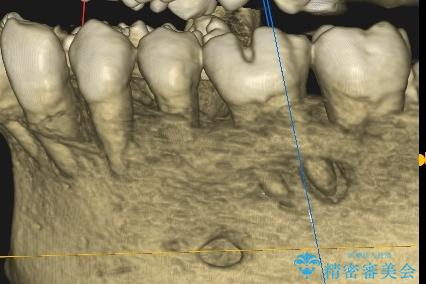 咬合力で破折した奥歯 抜歯即時埋入インプラントによる補綴治療の治療前