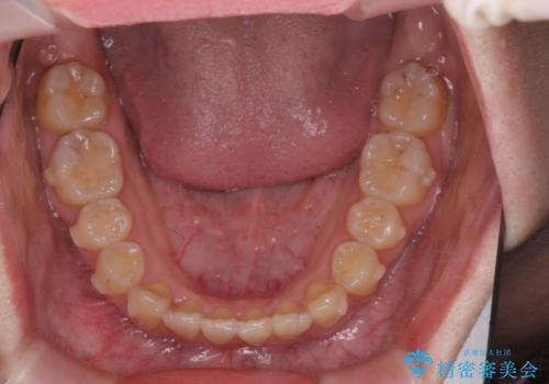 前歯のねじれ 矯正治療による歯並び改善の治療中