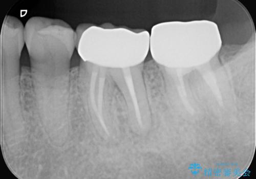 奥歯の痛みも、顕微鏡で精密に解消の治療後