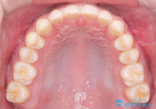 【ワイヤー矯正】歯列の隙間を閉じたいの治療後