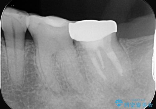 奥歯の痛みも、顕微鏡で精密に解消の治療前