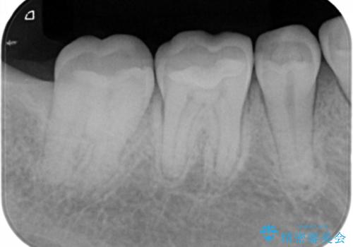 奥歯の虫歯を治療したい セラミックインレーの治療後