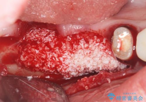 遊離歯肉移植術を伴うインプラント治療の治療前