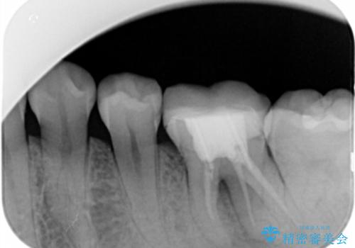 左下奥歯が腫れて痛い　フルジルコニアクラウンの治療前