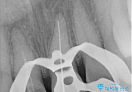 前歯の色が気になる!|他院で抜歯と言われた|歯を残したい|精密根管治療とオールセラミッククラウンで治療の治療中