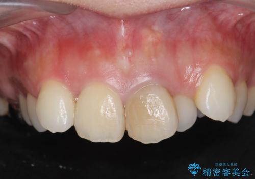 著しいがたつきによる清掃困難  歯牙抜去とセラミック治療の症例 治療前