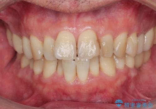 ナイトガードで歯の予防!の症例 治療前