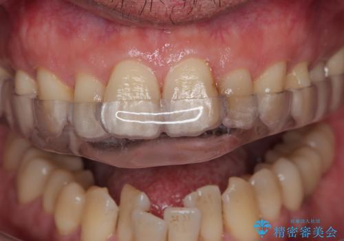 ナイトガードで歯の予防!の症例 治療後