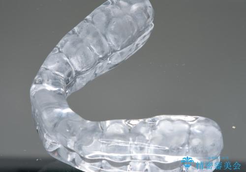 ナイトガードで歯の予防!の治療中