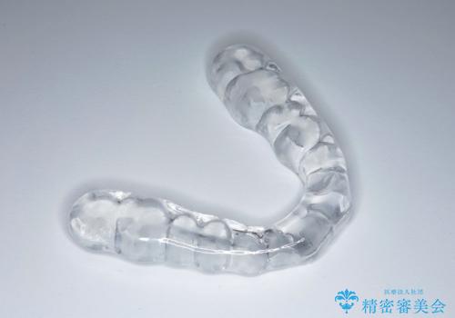 ナイトガードで歯の予防!の治療中