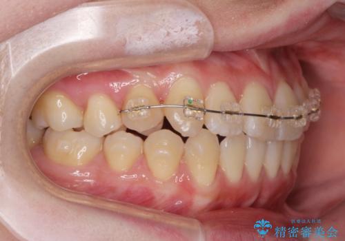 前歯のねじれ 矯正治療による歯並び改善の治療前