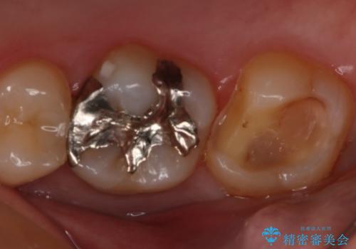 奥歯の再治療をしたい ゴールドインレーの治療中