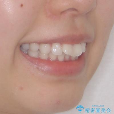 膨らんだ口元を改善する抜歯矯正 インプラント治療も同時に行う総合歯科治療の治療前(顔貌)