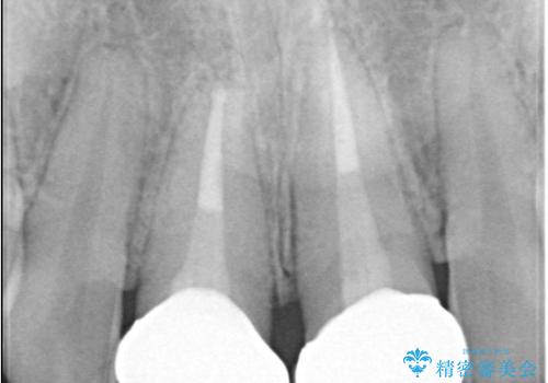 前歯の見た目と根の悩みを根本から解決の治療後