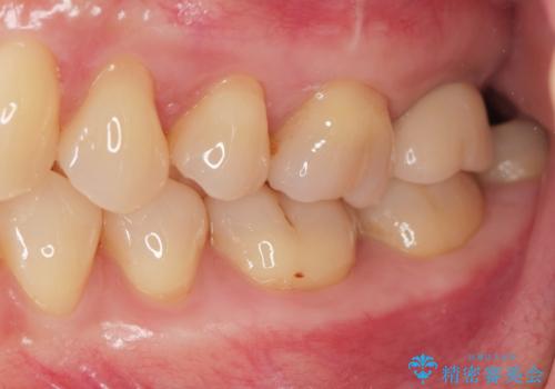 噛むと歯が疼く 歯牙破折からのインプラント治療の治療後