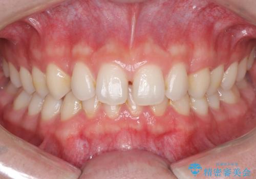 【ワイヤー矯正】歯列の隙間を閉じたいの治療前