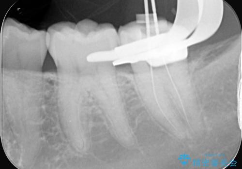 奥歯の激しい痛みを解消し、歯を長持ちさせる精密治療の治療中