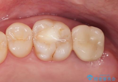 噛むと歯が疼く 歯牙破折からのインプラント治療の治療後
