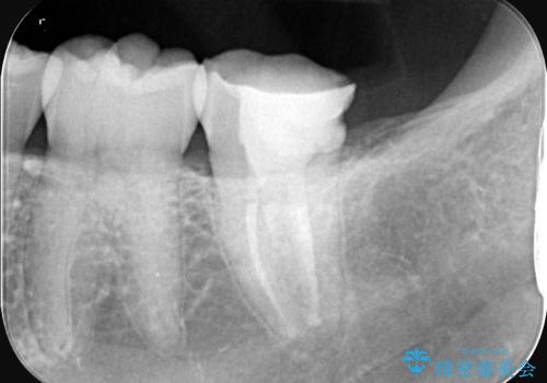 奥歯の激しい痛みを解消し、歯を長持ちさせる精密治療の治療後