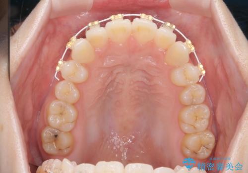 前歯のねじれをきれいに 部分ワイヤー+マウスピース矯正の治療前