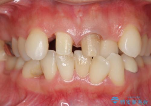 著しいがたつきによる清掃困難 歯牙抜去とセラミック治療の治療中