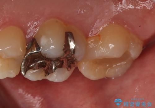 奥歯の再治療をしたい　ゴールドインレーの治療前