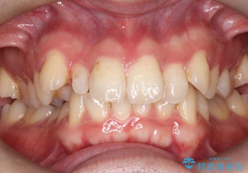 【セラミッククラウン】【精密根管治療】前歯が痛いの治療中