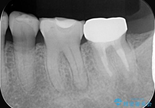 奥歯の痛みも、顕微鏡で精密に解消の治療前