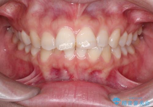 前歯のデコボコを、目立たない矯正で解消の治療前