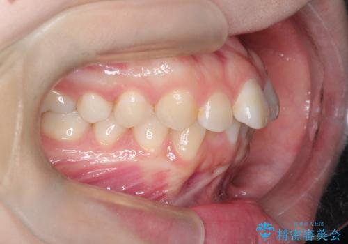 前歯のデコボコを、目立たない矯正で解消の治療前