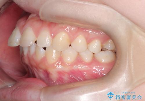 前歯のデコボコを、目立たない矯正で解消の治療前