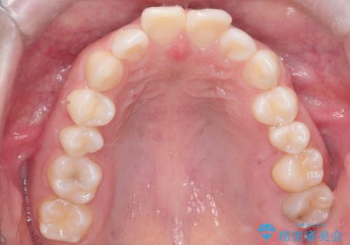 前歯のデコボコを、目立たない矯正で解消の治療前