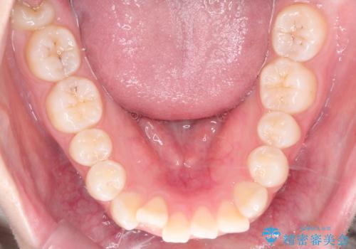 前歯のデコボコを、目立たない矯正で解消の治療前