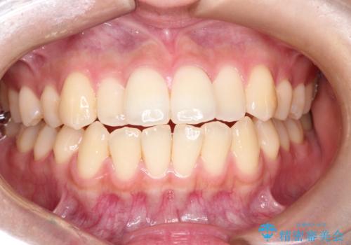 前歯のデコボコと突出を、目立たない矯正で解消の症例 治療前