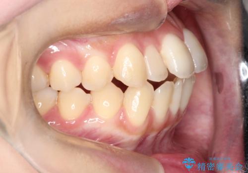 前歯のデコボコと突出を、目立たない矯正で解消の治療前